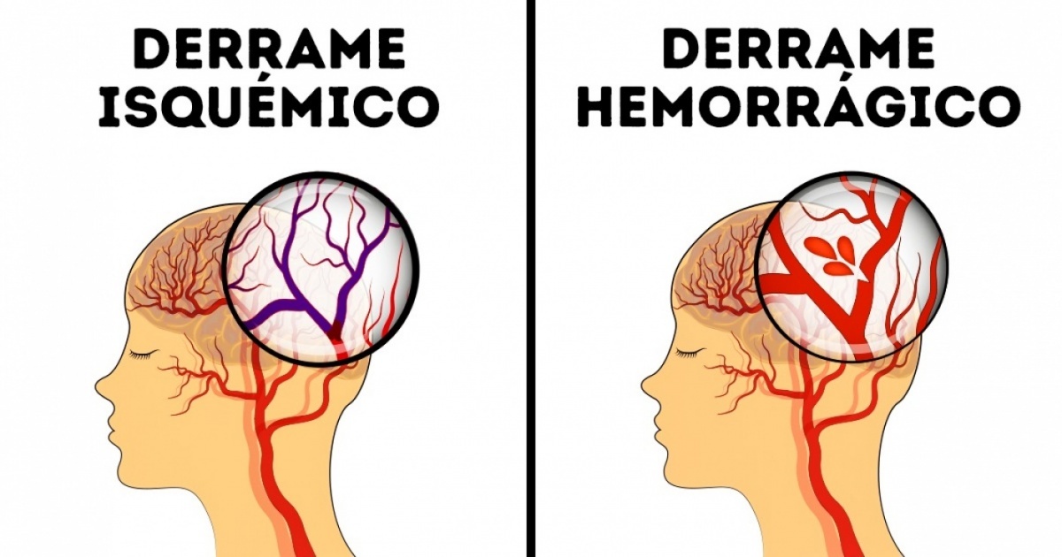 los-7-sintomas-que-te-ayudaran-a-identificar-derrames-cerebrales-en-mujeres-politicas-de-facebook